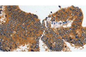 Immunohistochemistry of paraffin-embedded Human colon cancer tissue using GluR2 Polyclonal Antibody at dilution 1:70 (GRIA2 抗体)