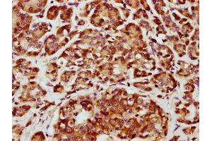 IHC image of ABIN7146684 diluted at 1:800 and staining in paraffin-embedded human pancreatic cancer performed on a Leica BondTM system. (CHST14 抗体  (AA 70-133))