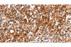 Immunohistochemistry of paraffin-embedded Human prostate cancer tissue using TRIM69 Polyclonal Antibody at dilution 1:40 (TRIM69 抗体)