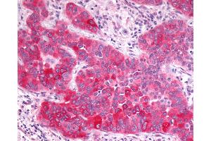 Anti-GPR17 antibody IHC of human Lung, Non-Small Cell Carcinoma. (GPR17 抗体  (N-Term))