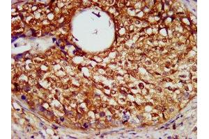 IHC image of ABIN7169341 diluted at 1:600 and staining in paraffin-embedded human cervical cancer performed on a Leica BondTM system. (SERPINB4 抗体  (AA 128-208))