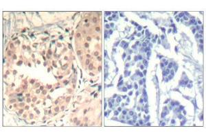 Immunohistochemical analysis of paraffin-embedded human breast carcinoma tissue using CDK6 (phospho-Tyr13) Antibody (E011542). (CDK6 抗体  (pTyr13))