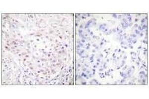 Immunohistochemistry analysis of paraffin-embedded human breast carcinoma tissue, using SENP3 antibody. (SENP3 抗体)