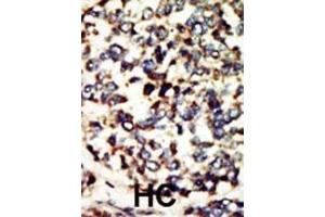 Formalin-fixed and paraffin-embedded human cancer tissue reacted with the primary antibody, which was peroxidase-conjugated to the secondary antibody, followed by DAB staining. (NEK7 抗体  (N-Term))