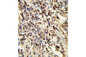Formalin-fixed and paraffin-embedded human lung carcinoma reacted with PSMA7 Antibody , which was peroxidase-conjugated to the secondary antibody, followed by DAB staining. (PSMA7 抗体  (AA 100-126))