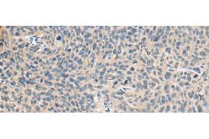 Immunohistochemistry of paraffin-embedded Human cervical cancer tissue using RNASE1 Polyclonal Antibody at dilution of 1:50(x200) (RNASE1 抗体)