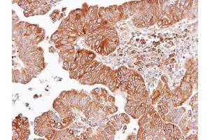 IHC-P Image Immunohistochemical analysis of paraffin-embedded human lung SCC, using Dishevelled 2, antibody at 1:100 dilution. (DVL2 抗体  (Internal Region))