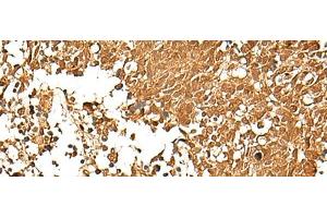 Immunohistochemistry of paraffin-embedded Human lung cancer tissue using TCF7 Polyclonal Antibody at dilution of 1:30(x200) (TCF7 抗体)