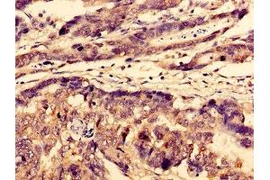 Immunohistochemistry of paraffin-embedded human gastric cancer using ABIN7175699 at dilution of 1:100 (WDFY3 抗体  (AA 1-100))