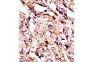 Formalin-fixed and paraffin-embedded human cancer tissue reacted with the primary antibody, which was peroxidase-conjugated to the secondary antibody, followed by AEC staining. (BCKDK 抗体  (Middle Region))