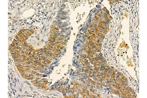 BCL7C Mouse Monoclonal Antibody at 1/100 staining human lung cancer and adjacent non-tumor tissue by IHC-P.
