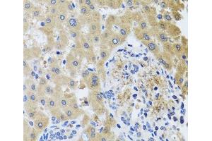 Immunohistochemistry of paraffin-embedded Human liver damage using RHOB Polyclonal Antibody at dilution of 1:100 (40x lens). (RHOB 抗体)
