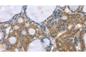 Immunohistochemistry of paraffin-embedded Human thyroid cancer using GNAT3 Polyclonal Antibody at dilution of 1:35 (GNAT3 抗体)