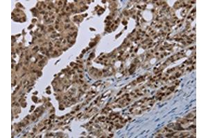 The image on the left is immunohistochemistry of paraffin-embedded Human ovarian cancer tissue using ABIN7191347(MAGEB18 Antibody) at dilution 1/20, on the right is treated with synthetic peptide. (MAGEB18 抗体)