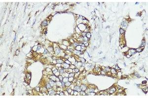 Immunohistochemistry of paraffin-embedded Human lung cancer using SOCS6 Polyclonal Antibody at dilution of 1:100 (40x lens). (SOCS6 抗体)