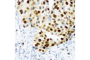 Immunohistochemical analysis of DDX39B staining in human prostate cancer formalin fixed paraffin embedded tissue section. (DDX39B 抗体)