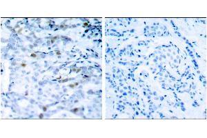 Immunohistochemical analysis of paraffin-embedded breast carcinoma, using CDC2(Phospho-Thr161) Antibody. (CDK1 抗体  (pThr161))