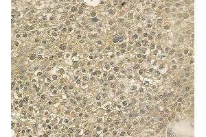ABIN6266101 and ABIN6273351 at 1/100 staining human hepatocellular carcinoma by IHC-P.