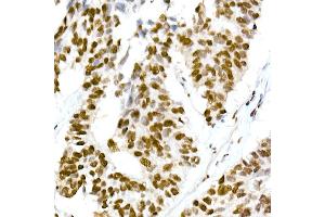 Immunohistochemistry of paraffin-embedded human lung cancer using RBM3 Rabbit mAb (ABIN7270084) at dilution of 1:25 (40x lens). (RBM3 抗体)