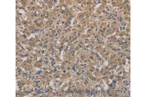 Immunohistochemistry of Human gastric cancer using AGTRAP Polyclonal Antibody at dilution of 1:40 (AGTRAP 抗体)