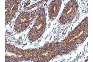 IHC-P Image Immunohistochemical analysis of paraffin-embedded human colon carcinoma, using CCDC37, antibody at 1:500 dilution. (CCDC37 抗体  (N-Term))