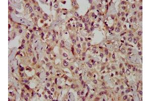 IHC image of  diluted at 1:1200 and staining in paraffin-embedded human liver cancer performed on a Leica BondTM system. (CD133 抗体  (AA 508-792))