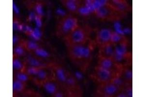 Immunofluorescence analysis of Human stomach cancer tissue using Catenin beta Monoclonal Antibody at dilution of 1:200. (beta Catenin 抗体)