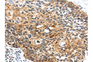 The image on the left is immunohistochemistry of paraffin-embedded Human esophagus cancer tissue using ABIN7127958(CENPM Antibody) at dilution 1/30, on the right is treated with fusion protein. (CENPM 抗体)