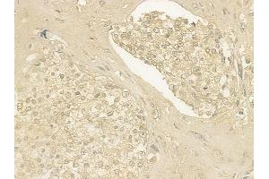 ABIN6259994 and ABIN6276620 at 1/100 staining human prostate carcinoma by IHC-P. (APOH 抗体  (C-Term))