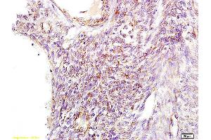 Formalin-fixed and paraffin embedded human cervical carcinoma tissue labeled with Anti GNPAT Polyclonal Antibody, Unconjugated (ABIN709106) at 1:100 followed by conjugation to the secondary antibody and DAB staining.
