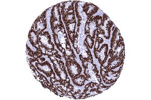 Colon Colorectal adenocarcinoma showing strong SATB2 immunostaining of all tumor cells (Recombinant SATB2 抗体  (AA 200-300))