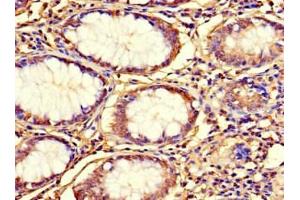 Immunohistochemistry of paraffin-embedded human colon cancer using ABIN7164582 at dilution of 1:100 (C12orf65 抗体  (AA 36-166))