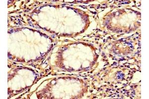 Immunohistochemistry of paraffin-embedded human colon cancer using ABIN7164582 at dilution of 1:100