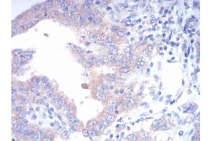 Immunohistochemical analysis of paraffin-embedded endometrial cancer tissues using FGFR3 mouse mAb with DAB staining. (FGFR3 抗体  (AA 529-694))