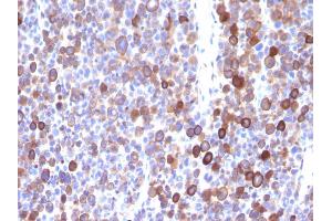 Formalin-fixed, paraffin-embedded human Melanoma stained with Moesin Mouse Monoclonal Antibody (MSN/491). (Moesin 抗体)
