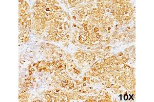 Formalin/paraffin human melanoma stained with MART-1 / Melan-A antibody (M2-9E3). (MLANA 抗体)