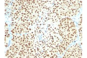 Formalin-fixed, paraffin-embedded human Melanoma stained with SOX10 Monoclonal Antibody (SPM607). (SOX10 抗体  (AA 115-269))