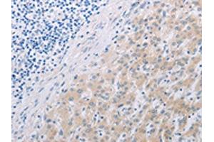 The image on the left is immunohistochemistry of paraffin-embedded Human liver cancer tissue using ABIN7191852(PFN2 Antibody) at dilution 1/30, on the right is treated with synthetic peptide. (PFN2 抗体)