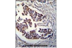 Rad9 Antibody  (ABIN655465 and ABIN2844992) immunohistochemistry analysis in formalin fixed and paraffin embedded human breast carcinoma followed by peroxidase conjugation of the secondary antibody and DAB staining. (RAD9A 抗体  (AA 365-391))