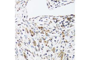Immunohistochemistry of paraffin-embedded human uterine cancer using DHRS2 antibody (ABIN5973846) at dilution of 1/100 (40x lens). (DHRS2 抗体)