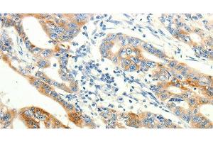 Immunohistochemistry of paraffin-embedded Human gasrtic cancer tissue using TRPA1 Polyclonal Antibody at dilution 1:60 (TRPA1 抗体)