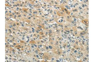 The image on the left is immunohistochemistry of paraffin-embedded Human liver cancer tissue using ABIN7193074(XKR3 Antibody) at dilution 1/20, on the right is treated with synthetic peptide. (XKR3 抗体)