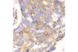 Immunohistochemistry of paraffin-embedded human esophageal cancer using CAPNS1 antibody.