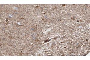 ABIN6278520 at 1/100 staining Human brain cancer tissue by IHC-P. (SGCB 抗体  (N-Term))