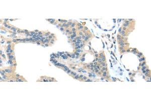 Immunohistochemistry of paraffin-embedded Human thyroid cancer tissue using VPS36 Polyclonal Antibody at dilution 1:40 (VPS36 抗体)