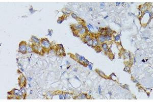Immunohistochemistry of paraffin-embedded Human lung cancer using ACADL Polyclonal Antibody at dilution of 1:100 (40x lens). (ACADL 抗体)