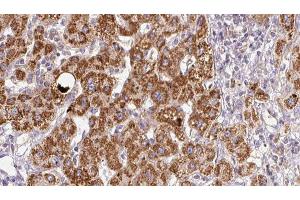 ABIN6278960 at 1/100 staining Human liver cancer tissue by IHC-P. (XCR1 抗体)