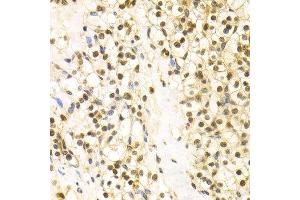 Immunohistochemistry of paraffin-embedded human kidney cancer using BAG1 antibody at dilution of 1:100 (x400 lens).