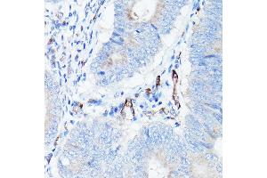 Immunohistochemistry of paraffin-embedded human colon carcinoma using CDH5 Rabbit pAb (ABIN6134029, ABIN6138297, ABIN6138298 and ABIN6216033) at dilution of 1:150 (40x lens). (Cadherin 5 抗体  (AA 650-750))