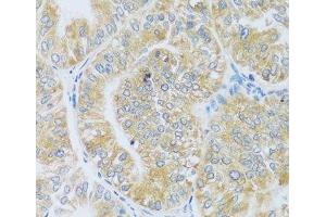 Immunohistochemistry of paraffin-embedded Human uterine cancer using ASB4 Polyclonal Antibody at dilution of 1:100 (40x lens). (ASB4 抗体)